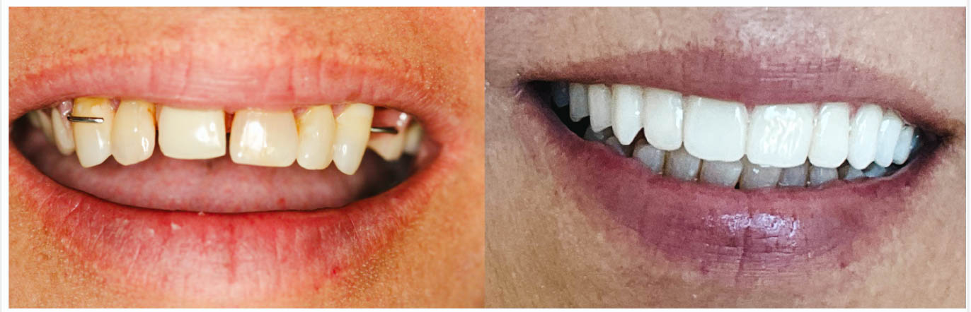 Invisalign in Arvada, CO