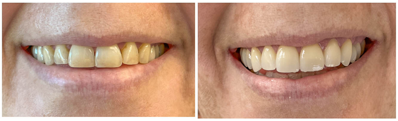 Before and After Custom Veneers in Arvada, CO