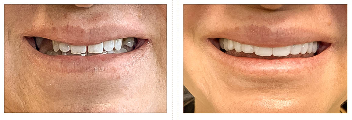 Before and After Dental Veneers in Arvada, CO