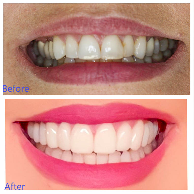 Professional Teeth Whitening in Arvada, CO