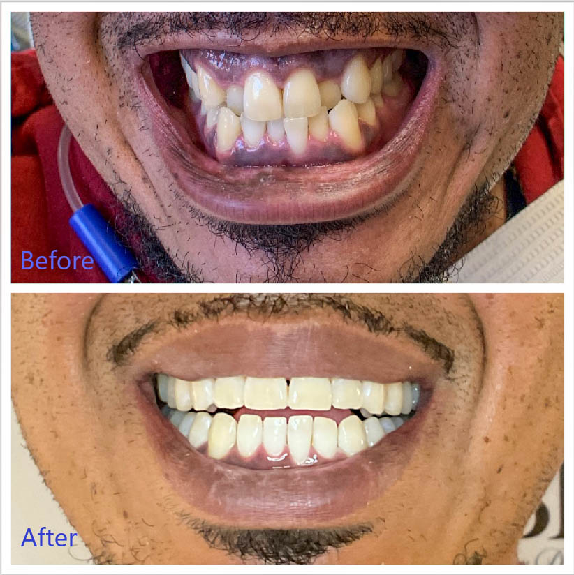 Before and After Clear Aligners in Arvada, CO