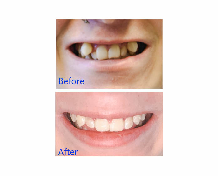 Before and After Clear Aligners in Arvada, CO