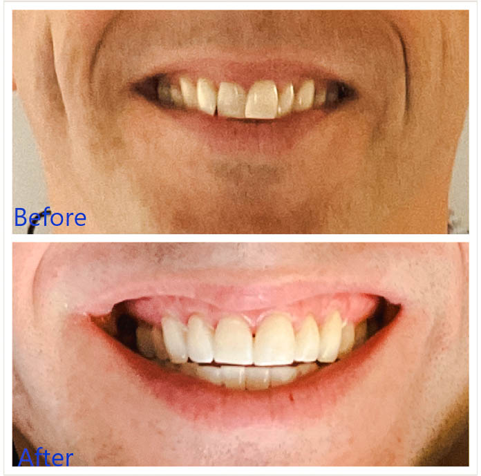 Teeth Straightening in Arvada, CO