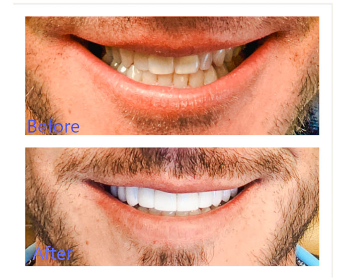 Before and After High-Quality Dental Veneers in Arvada, CO